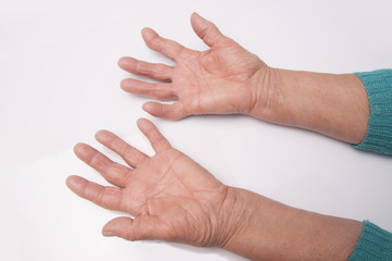 Hands With Rheumatoid Arthritis