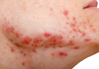 Young girl with skin problem