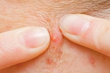 Fototapeta premium Acne squeezing
