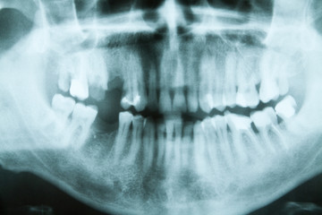 Dental X-ray