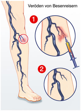 Besenreiser.Ver&ouml;den mit Spritze