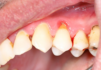gingivitis and atrophy