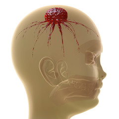 Hirntumor - 3D Render