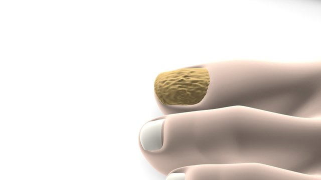 Nagelpilz - Nail fungus