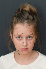 chickenpox varicella zoster virus