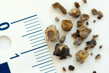 Kidney stones after ESWL intervention. Lithotripsy. Macro shot