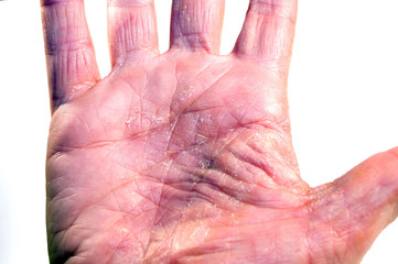Handfläche links Krankheit