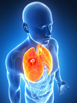 3d rendered illustration of the male lung - cancer