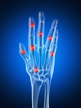 3d rendered illustration of an arthritic hand