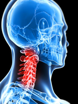 3d rendered illustration of a painful neck