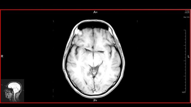 Brain top MRT scan