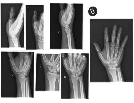 Real X-rays of the Hand and wrist. (broken wrist)