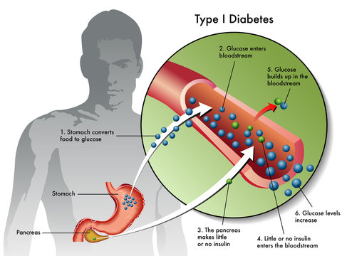 Diabete tipo 1