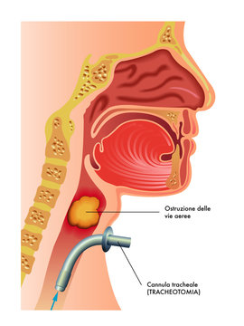 tracheotomia