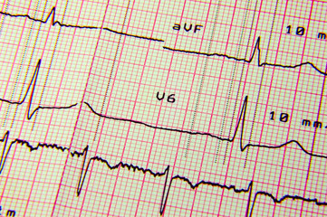 ECG EKG Reading Sheet