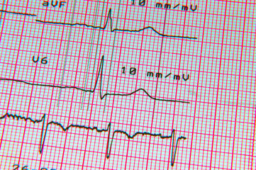 Electrocardiogram ECG