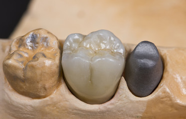 ceramic crown for molar teeth