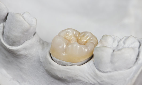 dental onlay on a cast model