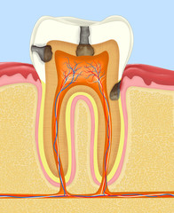 Medical illustration showing tooth decay affecting enamel and dentin with visible pulp and nerve structure. Suitable for dental education and healthcare materials.