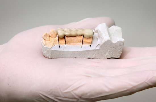 Dentist hold artificial tooth, and plaster model in hand