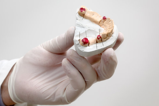 Dentist holding  plaster model of tooth in hand