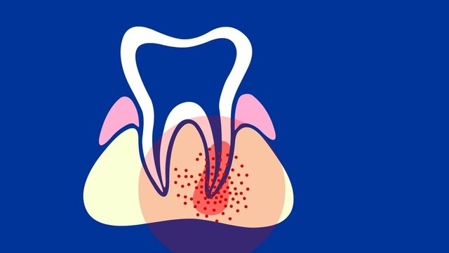 Zahnwurzelentz&uuml;ndung
