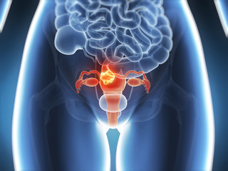 3d rendered illustration - uterus cancer