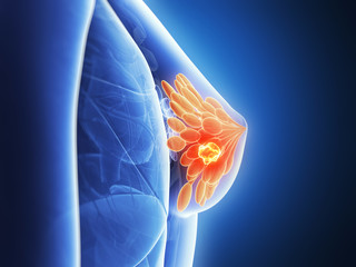 3d rendered illustration - breast cancer