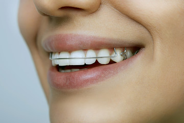 smiling girl with retainer on teeth - obrazy, fototapety, plakaty