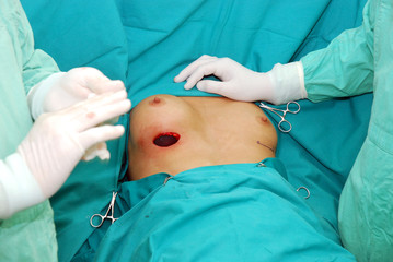 Breast augmentation, surgeon cutting the breast.