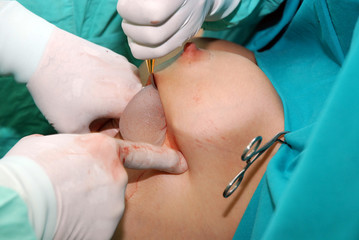 Breast augmentation surgery