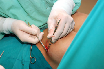 Breast augmentation surgery