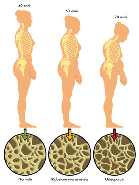 osteoporosi 3