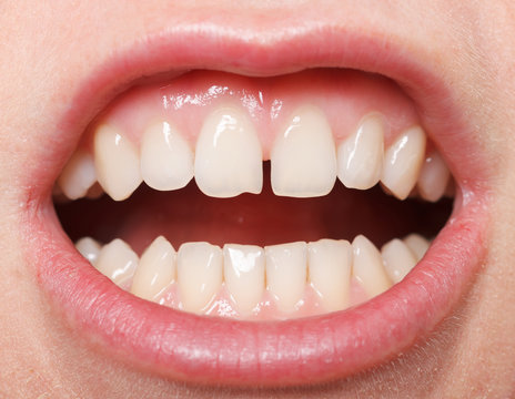 Diastema  between the upper incisors