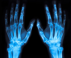 x-ray of an hand (blue) - 49870690