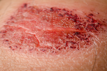 medical incrustation scab