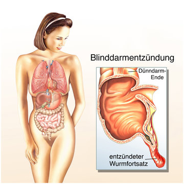 Blinddarmentz&uuml;ndung
