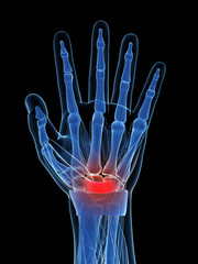 Naklejka premium 3d rendered illustration of the carpal tunnel syndrome