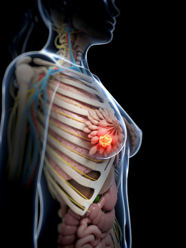 3d rendered illustration of breast cancer