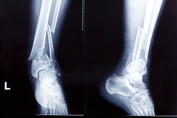 X-rays of leg fracture patients