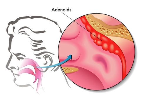 adenoidi