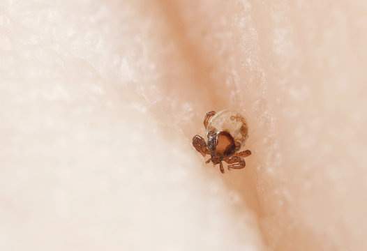 Tick Larva Feeding On Human, Extreme Close-up