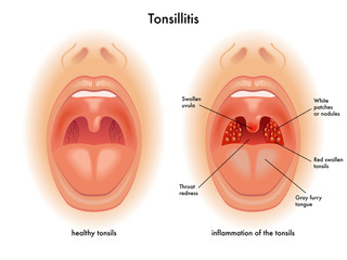 tonsillite
