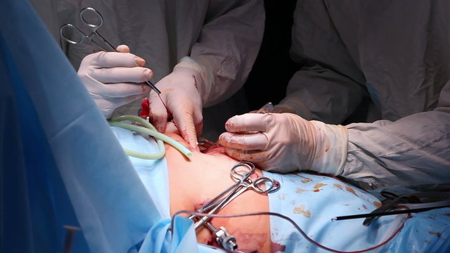 Laparoscopic surgery of the abdomen 2