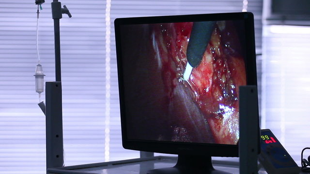 laparoscopic surgery on the monitor