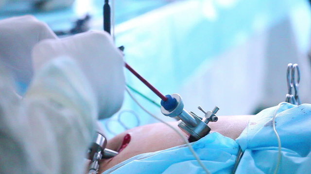 Laparoscopic surgery of the abdomen 12