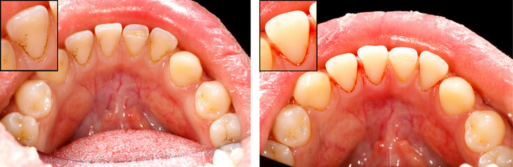 Clean teeth - before and after