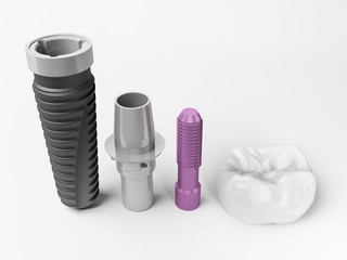 dental implant
