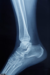 X-rays of leg fracture patients