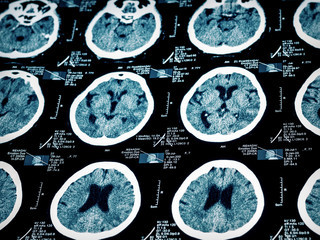 Computed tomography of human brain - 50453442